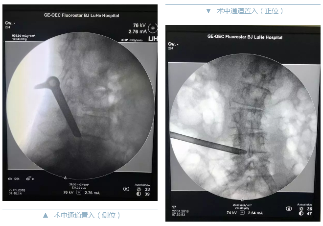 术中对比图.jpg