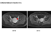 局晚期宫颈癌放疗疗效前后对比4