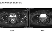 直肠癌新辅助放疗疗效前后对比1