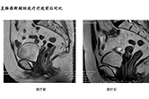 直肠癌新辅助放疗疗效前后对比3